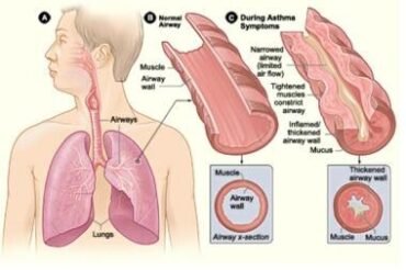What Causes Asthma In Older Adults: Unveiling the Triggers