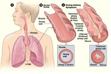 What Causes Asthma In Older Adults